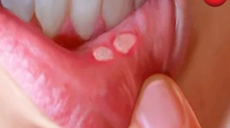 Mouth Ulcer Relief Tips
