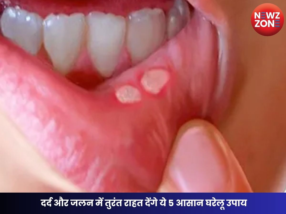 Mouth Ulcer Relief Tips