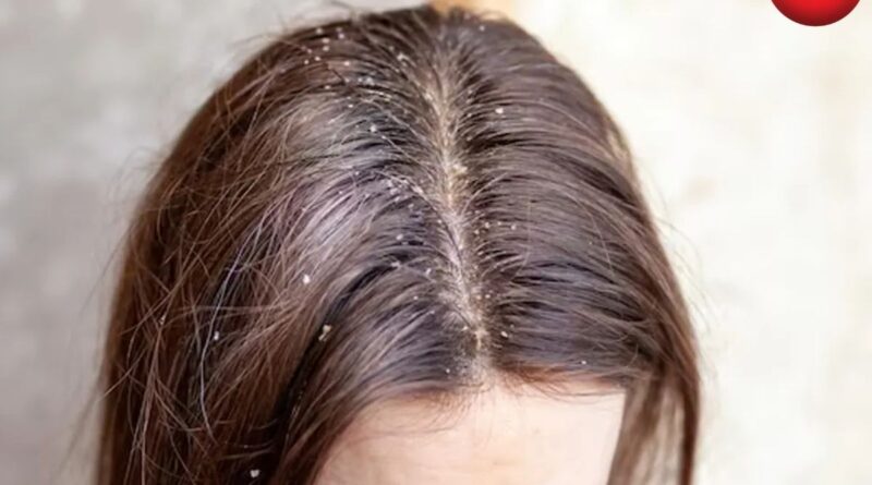 Home Remedies For Itchy Scalp