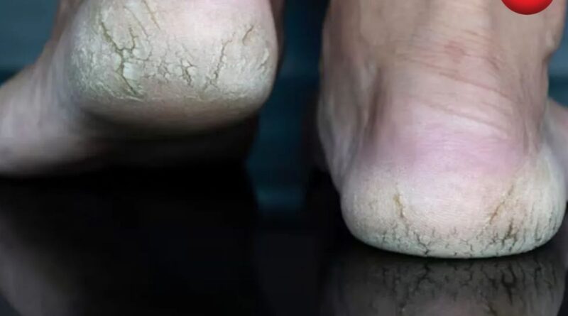 Winter Heel Care Tips