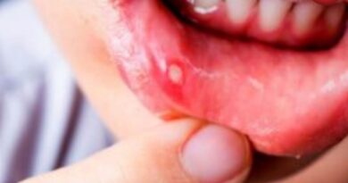 Mouth Ulcers Home Remedies