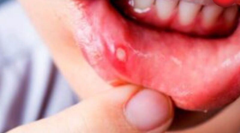 Mouth Ulcers Home Remedies