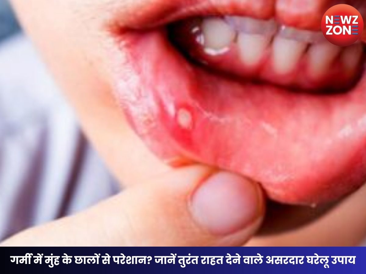 Mouth Ulcers Home Remedies: गर्मी में मुंह के छालों से परेशान? जानें तुरंत राहत देने वाले असरदार घरेलू उपाय
