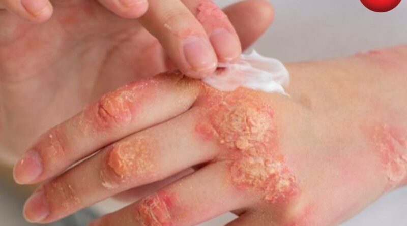 Fungal Infections Alert