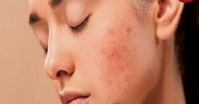 Monsoon Acne Tips