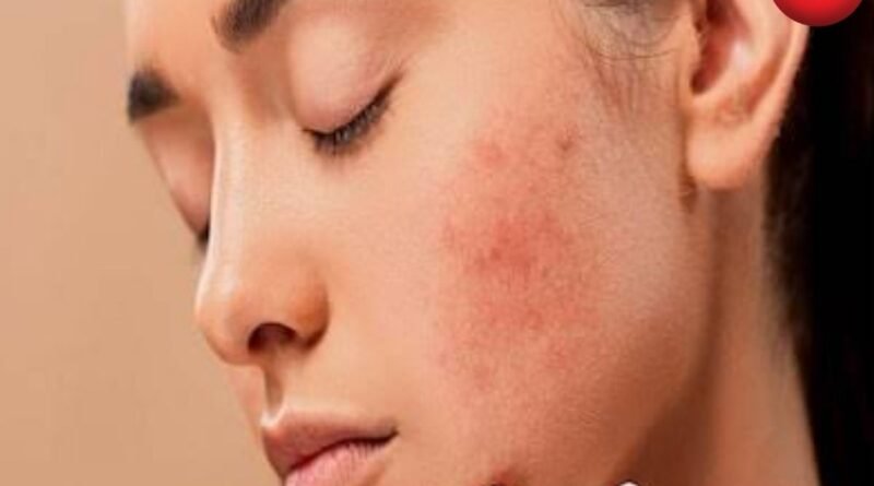 Monsoon Acne Tips