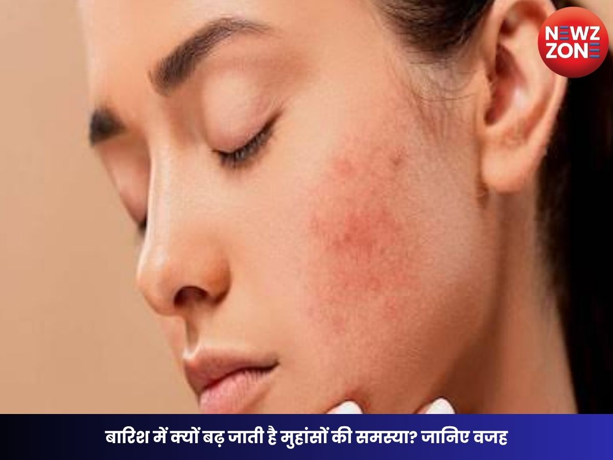 Monsoon Acne Tips: बारिश में क्यों बढ़ जाती है मुहांसों की समस्या? जानिए वजह, बचाव के आसान तरीके और मॉनसून स्किन केयर टिप्स