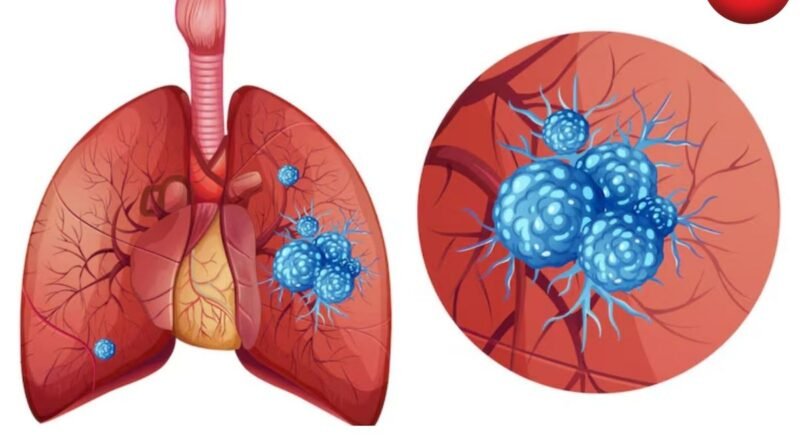 Lung Cancer Symptoms