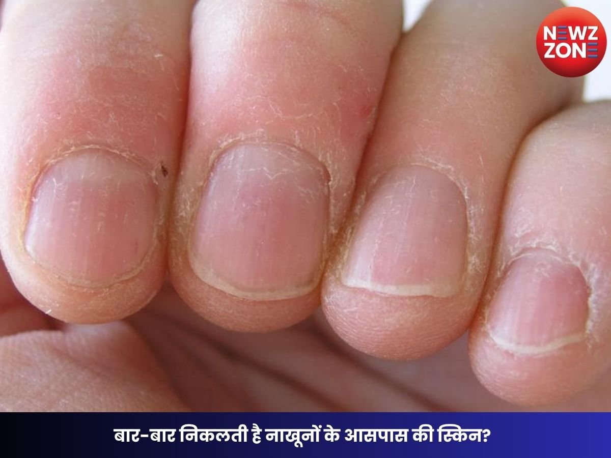 Nail Care: बार-बार निकलती है नाखूनों के आसपास की स्किन? जानिए हैंगनेल होने के कारण, बचाव के आसान तरीके और कब दिखाएं डॉक्टर